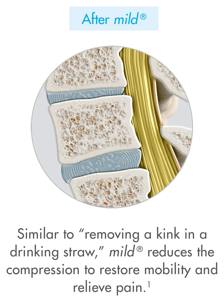 After mild®: similar to “removing a kink in a drinking straw,” mild® reduces the compression to restore mobility and relieve pain.