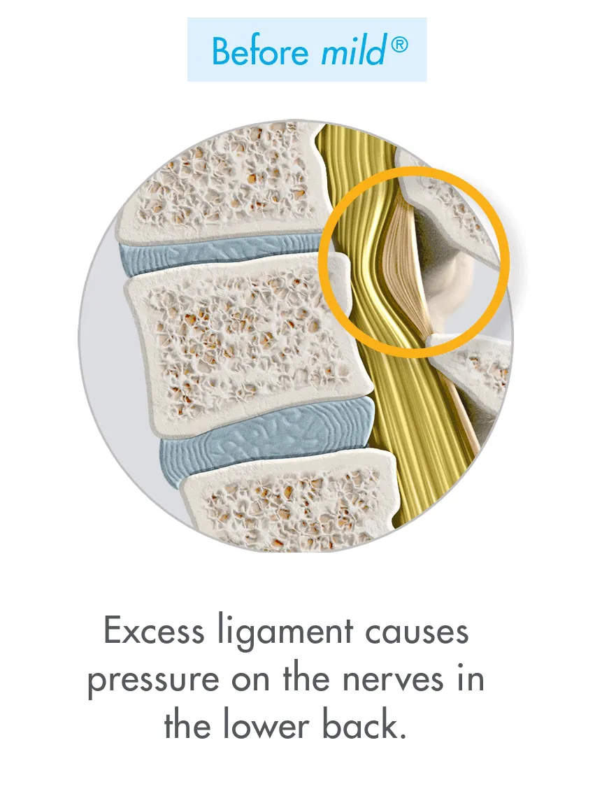 Before mild®: excess ligament causes pressure on the nerves in the lower back.